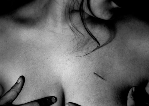 Cicatrices
